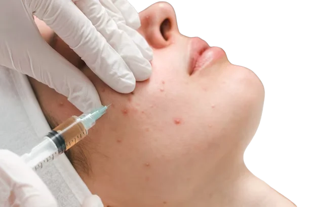 Medical Acne Treatment