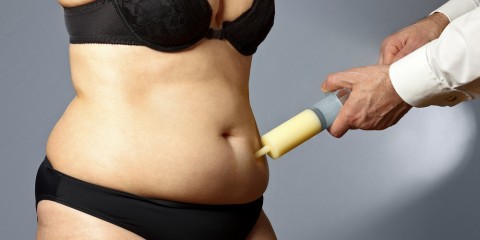 Tumescent Liposuction